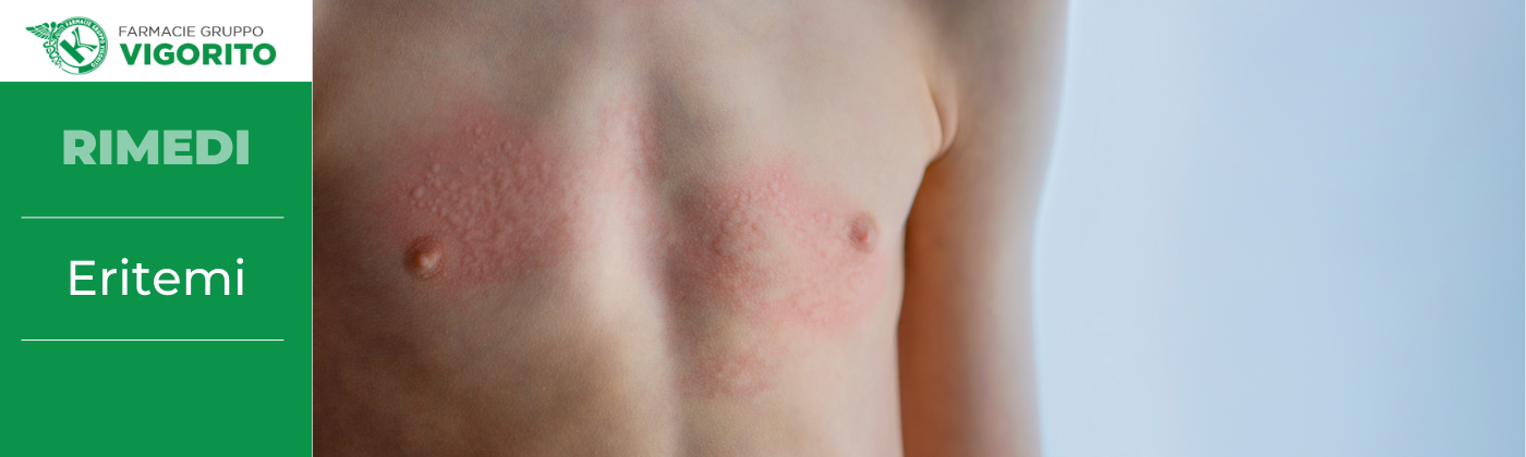 Eritemi