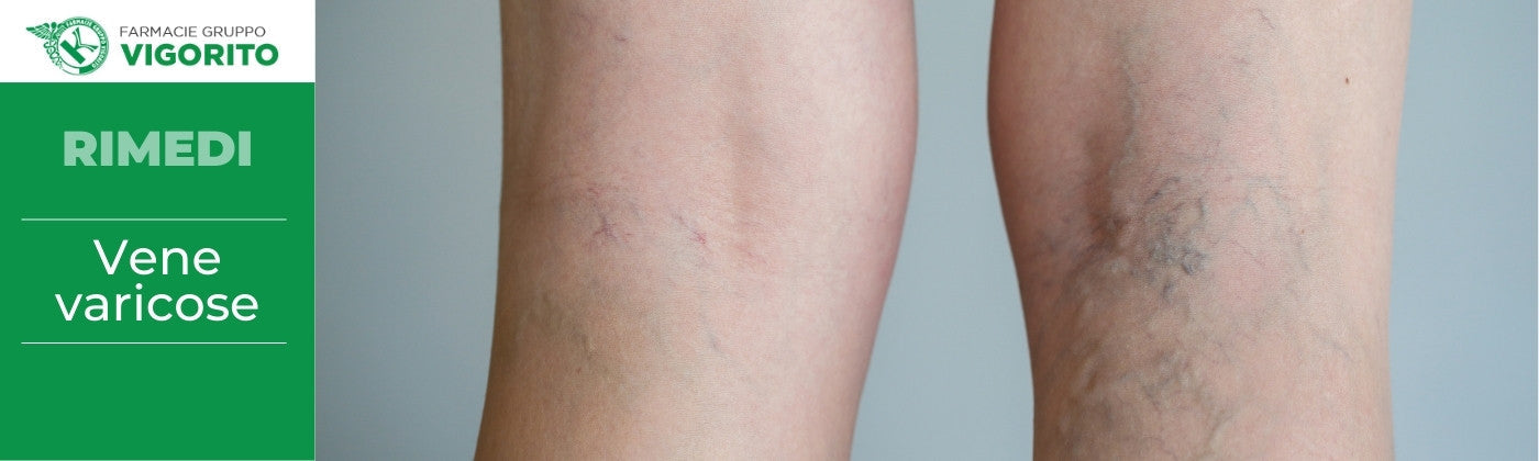Vene varicose