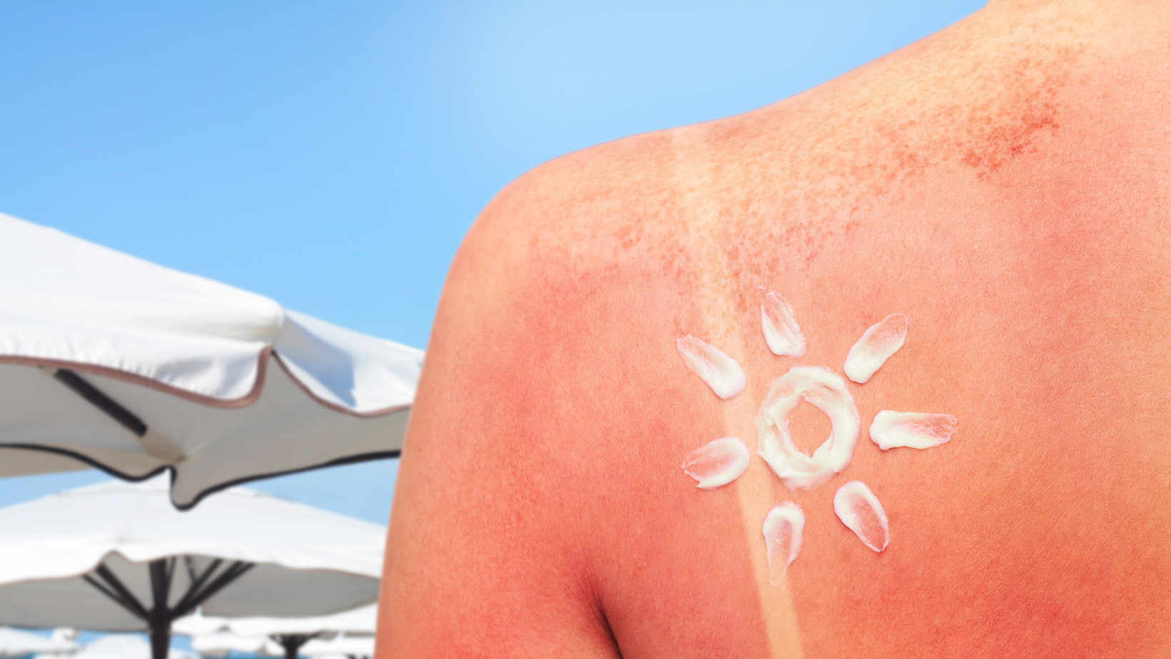 Scottatura solare sulla schiena con crema doposole a forma di sole sulla pelle arrossata e ombrelloni da spiaggia sullo sfondo