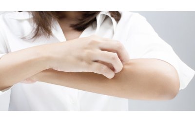 Psoriasi in estate: consigli utili per la pelle