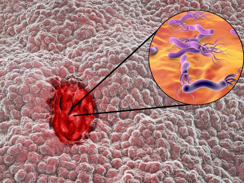 Helicobacter Pylori Complicazioni